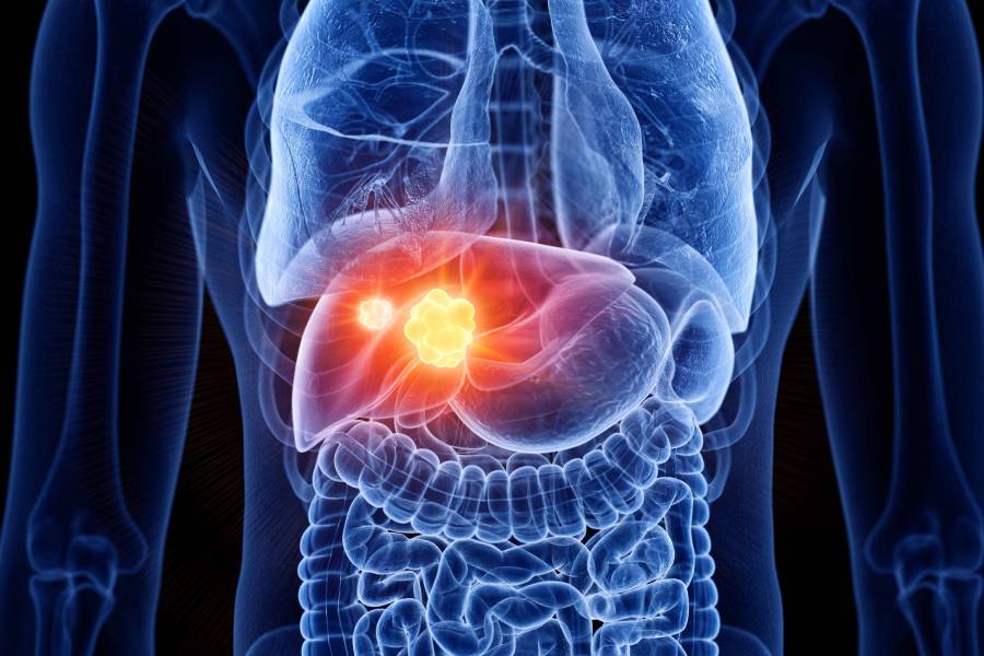 Liver Cancer Surgeon in Chennai