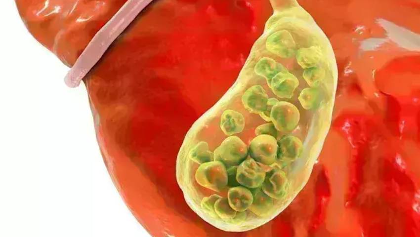 Choledocholithiasis vs. Cholelithiasis