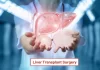Liver transplant surgery in Chennai by Dr. S. Srivatsan Gurumurthy, expert surgical gastroenterologist