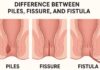 Difference Between Piles, Fissure, and Fistula explained by Dr. Srivatsan Gurumurthy