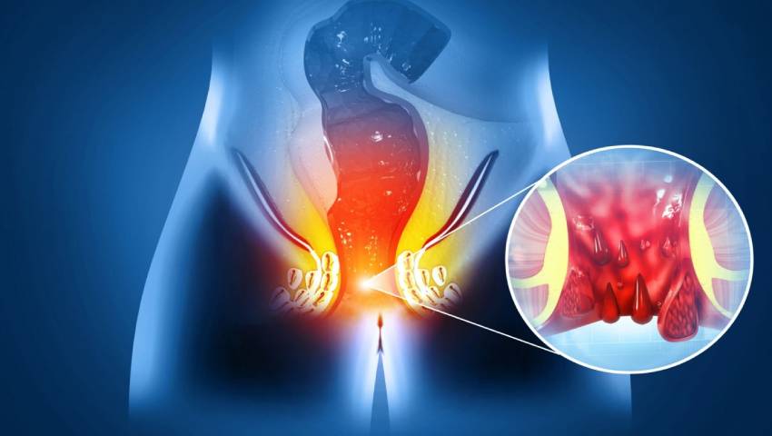 Post-operative care tips after piles and fistula surgery explained by Dr. S. Srivatsan Gurumurthy, Colorectal Surgeon in Chennai